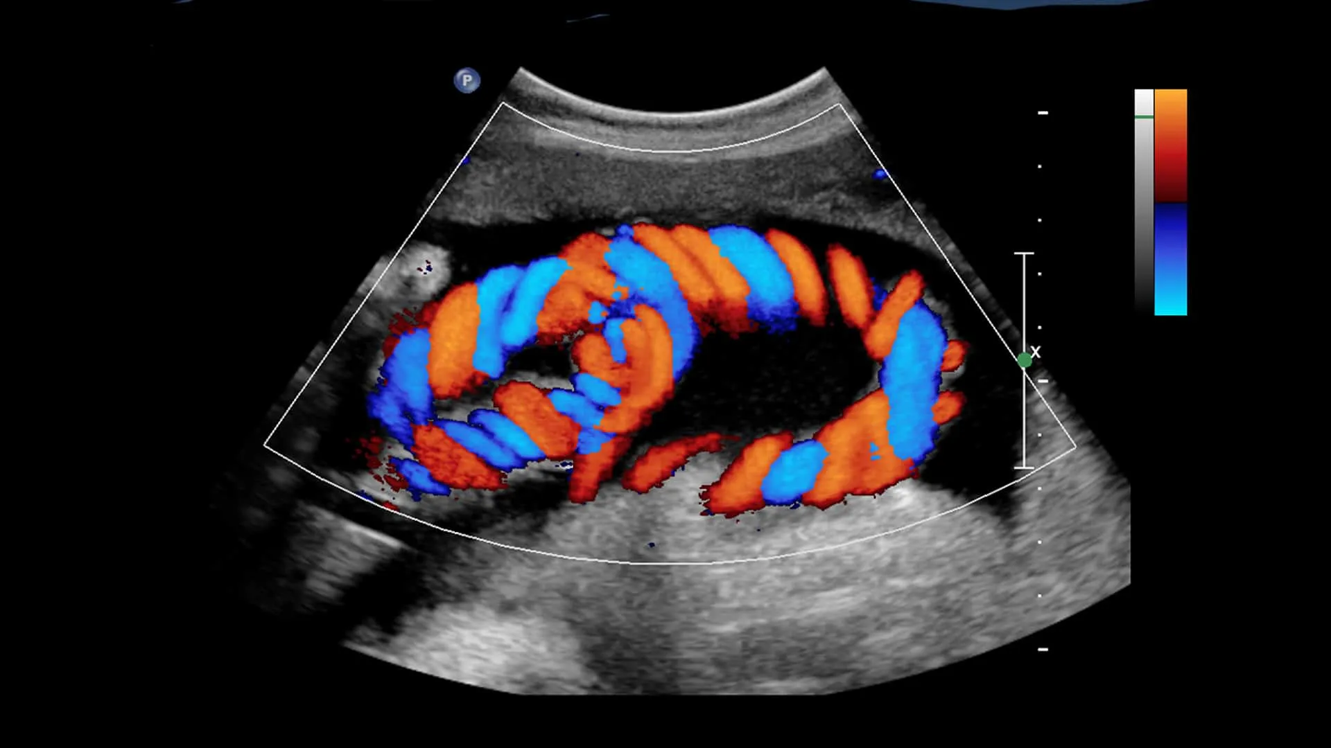 Doppler Ultrasound: What Is It and What To Expect?