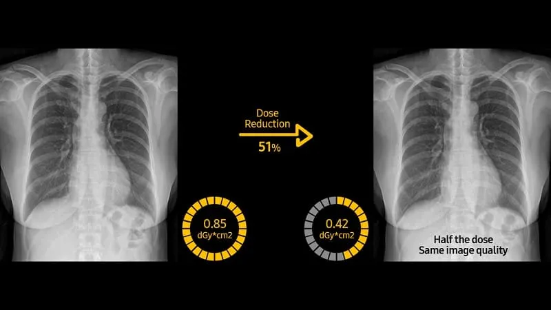 Digital X-Ray: Why is it
                                    Performed?